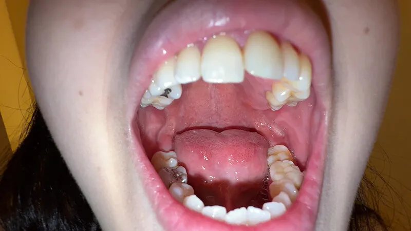 【個人撮影】横山夏希の喉チンコ触り＆肉厚舌を開口器で観察 サンプル画像 1