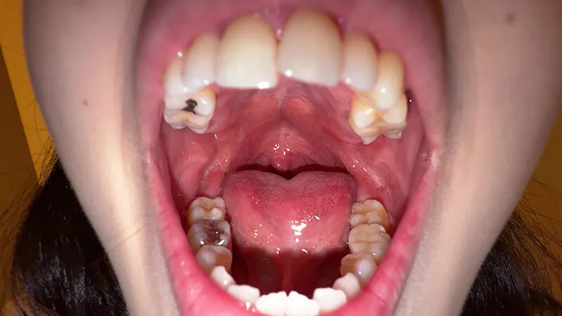 【個人撮影】横山夏希の喉チンコ触り＆肉厚舌を開口器で観察 サンプル画像 2
