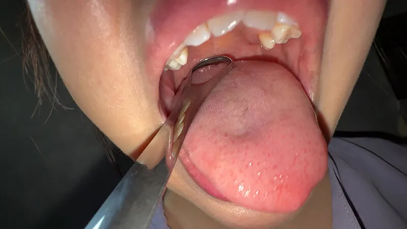 【個人撮影】谷田かりなの舌ブラシで「汚舌苔」採取 サンプル画像 15